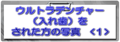 ウルトラデンチャー （入れ歯）を された方の写真　<１>